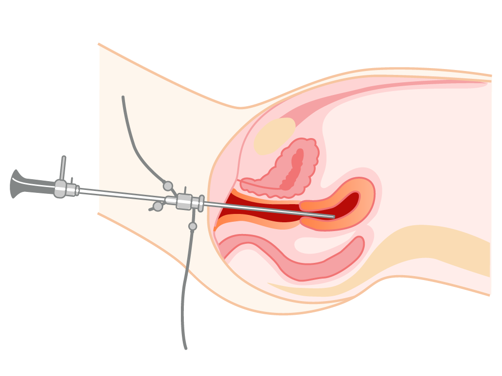 isteroscopia endometrio ispessito