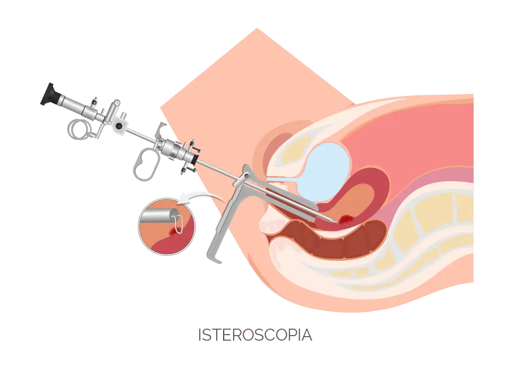 isteroscopia operativa