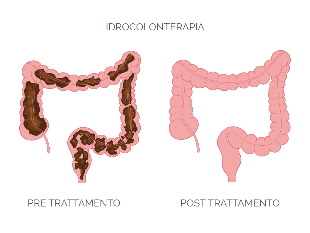 idrocolonterapia benefici