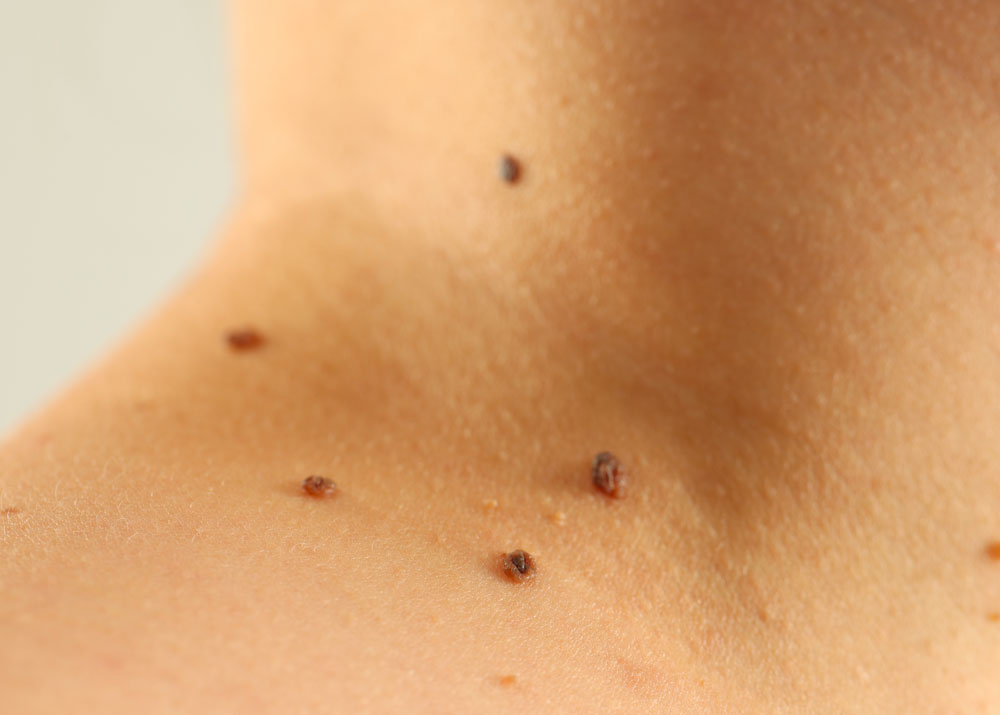melanoma milano