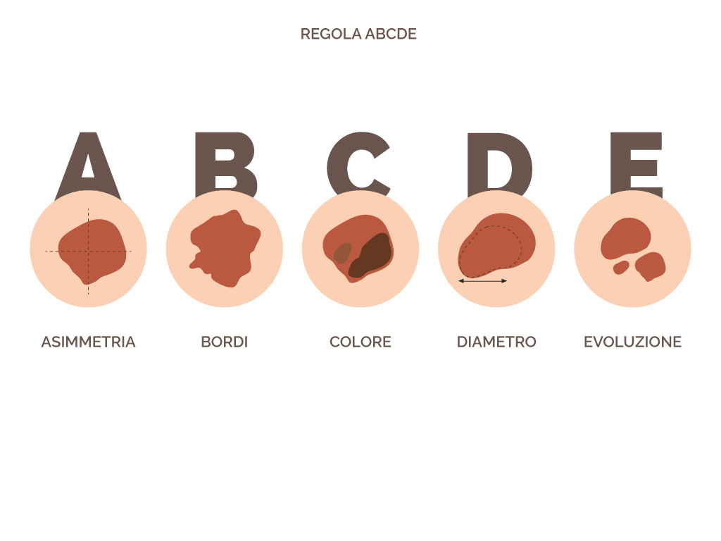 ABCDE melanoma