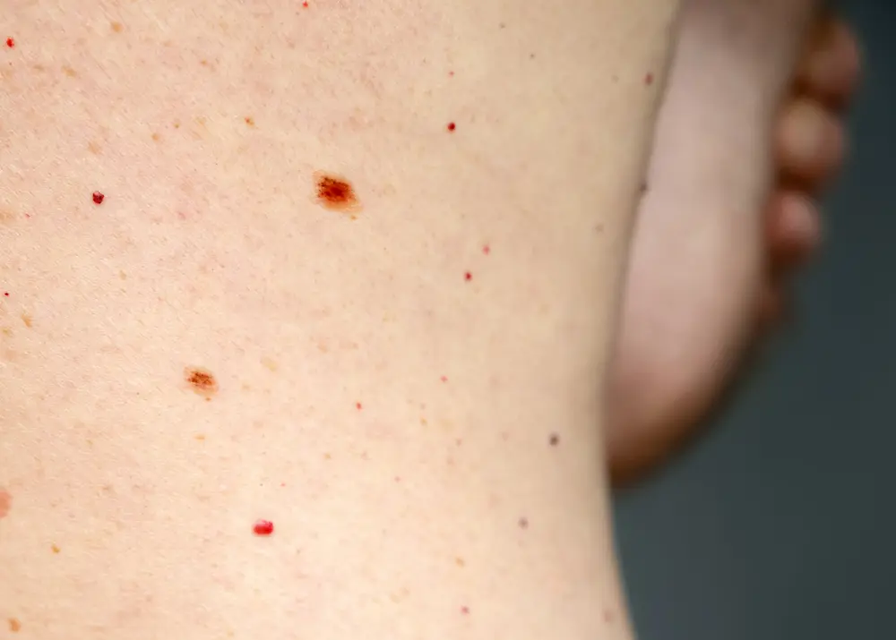 melanoma della pelle milano