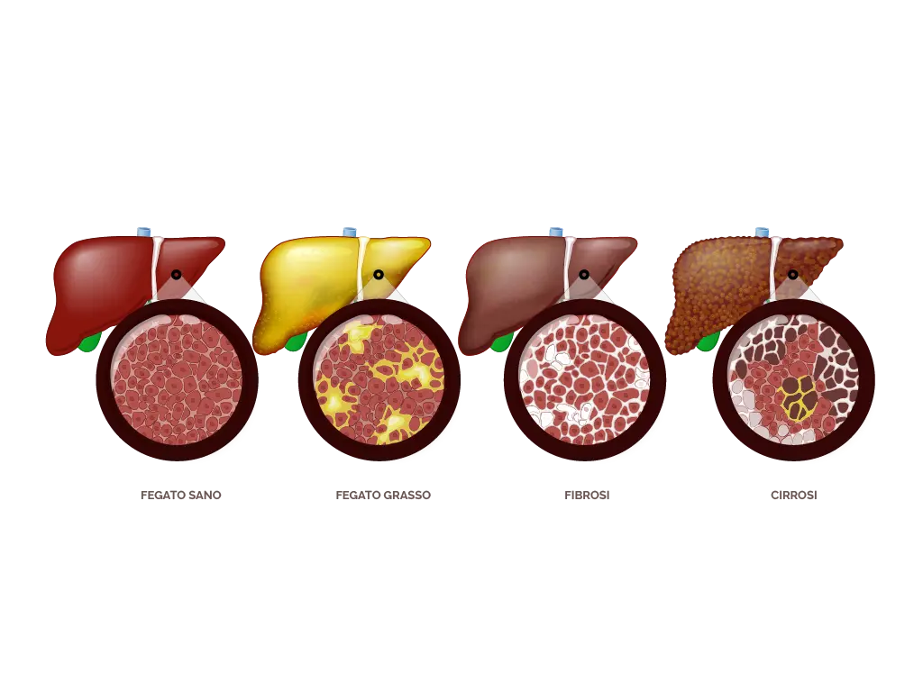 steatosi alcolica